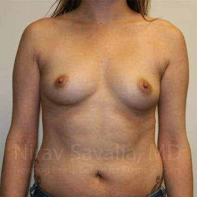 Breast Augmentation Before & After Gallery - Patient 1655557