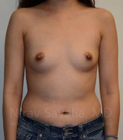 Breast Augmentation Before & After Gallery - Patient 1655566
