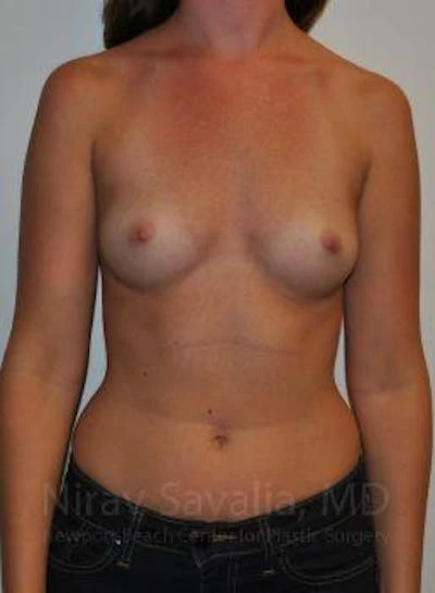 Breast Augmentation Before & After Gallery - Patient 1655574