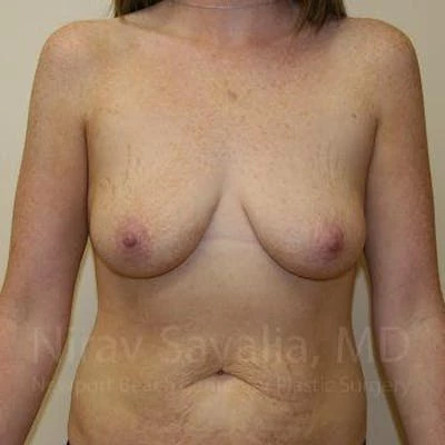 Breast Augmentation Before & After Gallery - Patient 1655579