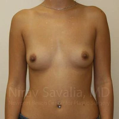 Breast Augmentation Before & After Gallery - Patient 1655586