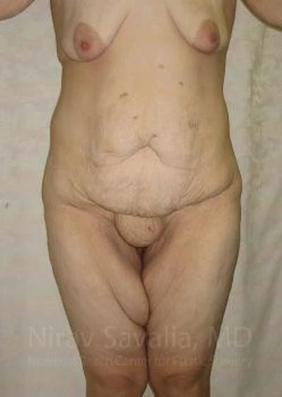 Thigh Lift Before & After Gallery - Patient 1655604