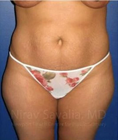 Abdominoplasty Tummy Tuck Before & After Gallery - Patient 1655614