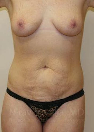 Abdominoplasty Tummy Tuck Before & After Gallery - Patient 1655627