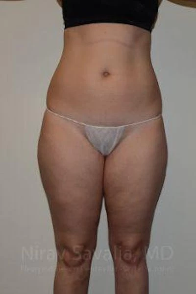 Liposuction Before & After Gallery - Patient 1655629