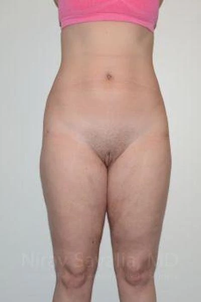 Liposuction Before & After Gallery - Patient 1655629