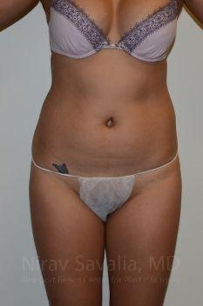 Liposuction Before & After Gallery - Patient 1655637 - Image 1