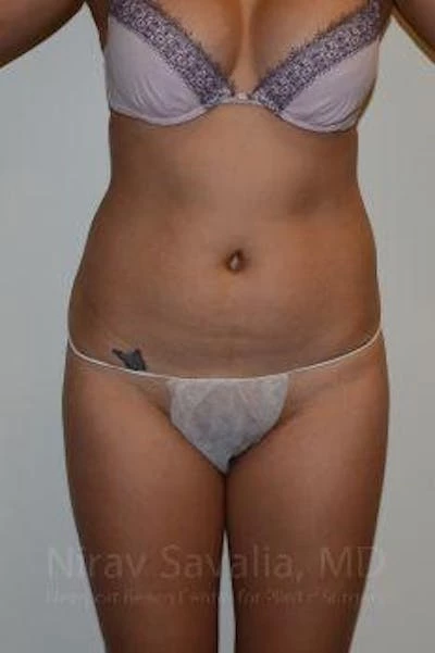 Liposuction Before & After Gallery - Patient 1655637