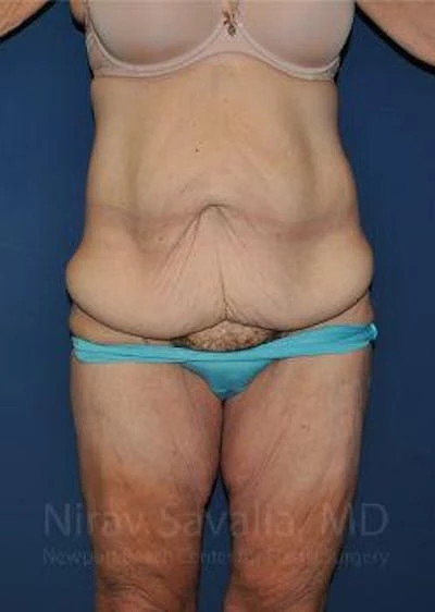 Abdominoplasty Tummy Tuck Before & After Gallery - Patient 1655638
