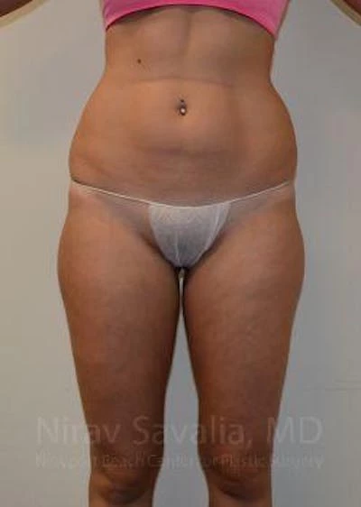 Liposuction Before & After Gallery - Patient 1655642