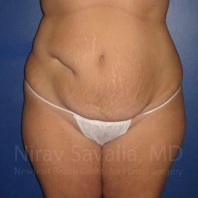 Liposuction Before & After Gallery - Patient 1655647
