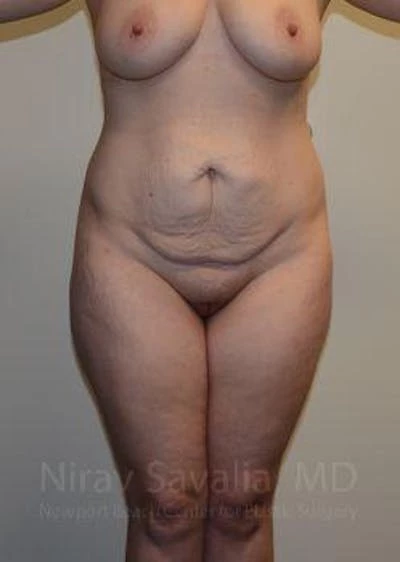Liposuction Before & After Gallery - Patient 1655652