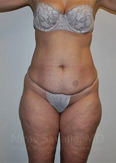 Liposuction Before & After Gallery - Patient 1655654