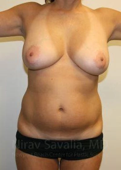 Liposuction Before & After Gallery - Patient 1655658