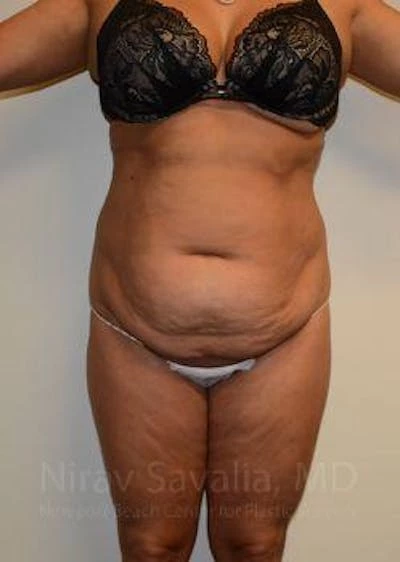 Abdominoplasty Tummy Tuck Before & After Gallery - Patient 1655659