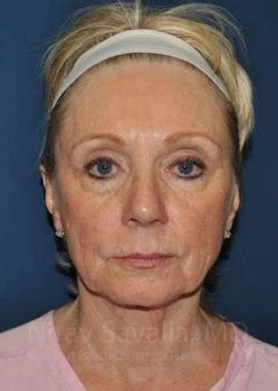 Fat Grafting to Face Before & After Gallery - Patient 1655681