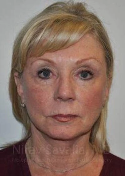 Fat Grafting to Face Before & After Gallery - Patient 1655681