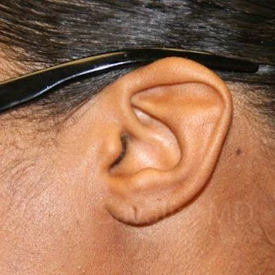 Torn Earlobe Repair Ear Gauge Repair Before & After Gallery - Patient 1655684