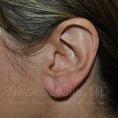 Torn Earlobe Repair Ear Gauge Repair Before & After Gallery - Patient 1655691