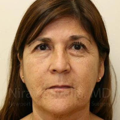 Brow Lift Before & After Gallery - Patient 1655702