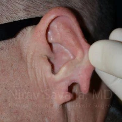 Torn Earlobe Repair Ear Gauge Repair Before & After Gallery - Patient 1655700