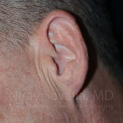  Before & After Gallery - Patient 1655700 - Image 2