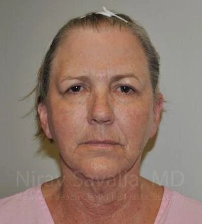 Fat Grafting to Face Before & After Gallery - Patient 1655705