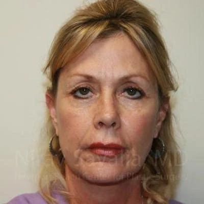 Brow Lift Before & After Gallery - Patient 1655706