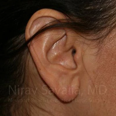 Torn Earlobe Repair Ear Gauge Repair Before & After Gallery - Patient 1655708