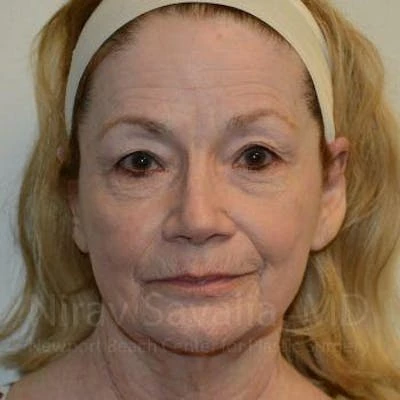 Fat Grafting to Face Before & After Gallery - Patient 1655710