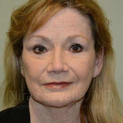 Fat Grafting to Face Before & After Gallery - Patient 1655710
