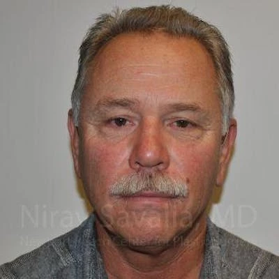 Eyelid Surgery Before & After Gallery - Patient 1655711