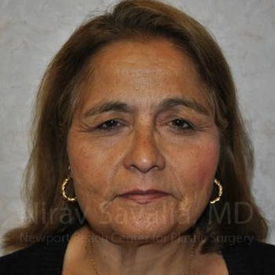 Eyelid Surgery Before & After Gallery - Patient 1655719