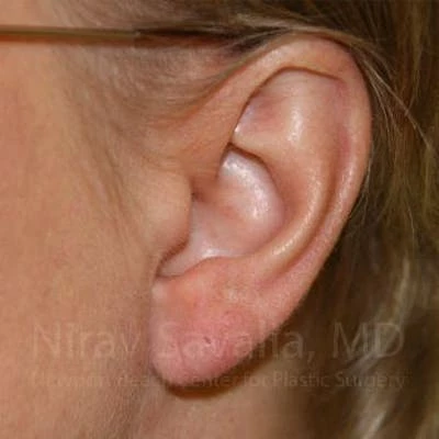 Torn Earlobe Repair Ear Gauge Repair Before & After Gallery - Patient 1655718