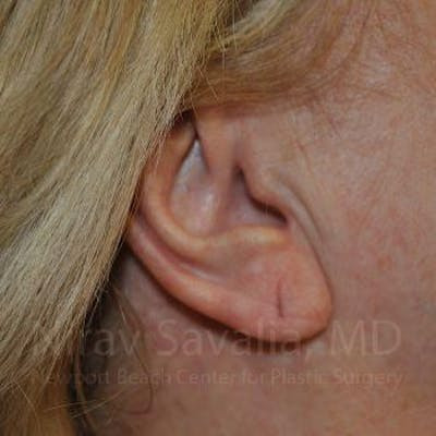  Before & After Gallery - Patient 1655722 - Image 1