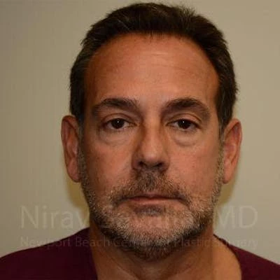 Eyelid Surgery Before & After Gallery - Patient 1655723