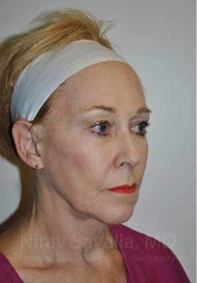 Fat Grafting to Face Before & After Gallery - Patient 1655725