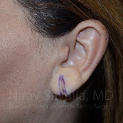 Torn Earlobe Repair Ear Gauge Repair Before & After Gallery - Patient 1655724