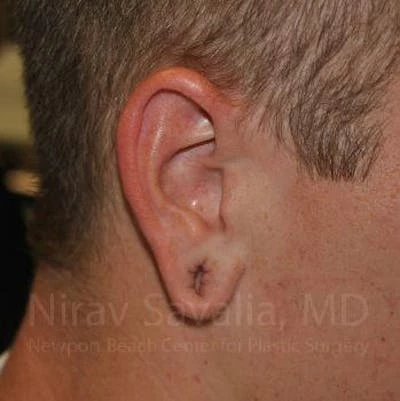 Torn Earlobe Repair Ear Gauge Repair Before & After Gallery - Patient 1655727
