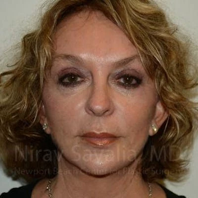 Fat Grafting to Face Before & After Gallery - Patient 1655730