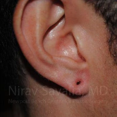Torn Earlobe Repair Ear Gauge Repair Before & After Gallery - Patient 1655790