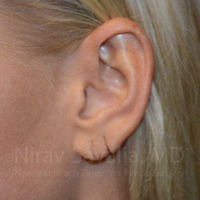  Before & After Gallery - Patient 1655792 - Image 1