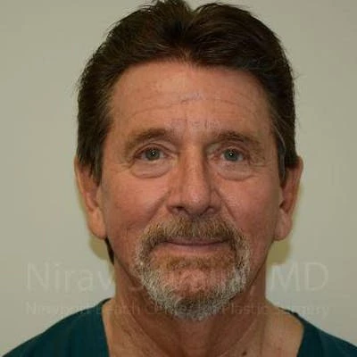 Eyelid Surgery Before & After Gallery - Patient 1655796
