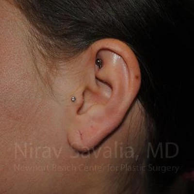 Torn Earlobe Repair Ear Gauge Repair Before & After Gallery - Patient 1655798