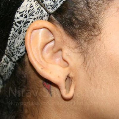 Torn Earlobe Repair Ear Gauge Repair Before & After Gallery - Patient 1655800