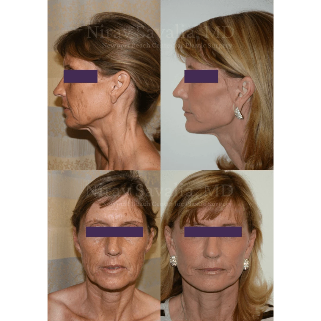 https://drsavalia.com/uploads/face_before_after_1.png