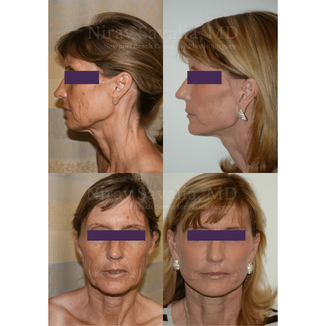 https://drsavalia.com/uploads/face_before_after_1.png