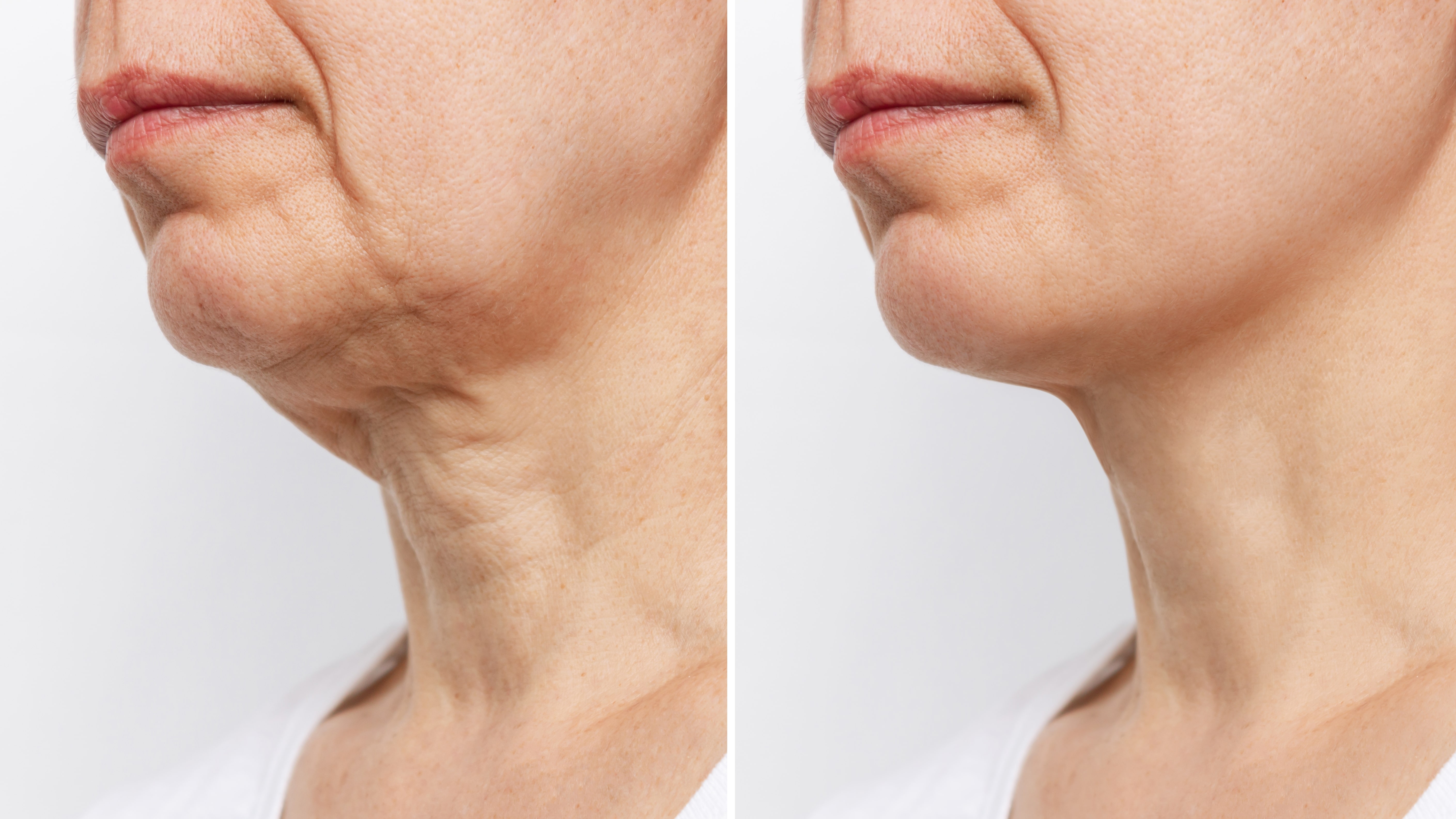 Facelift Alternatives: Exploring Non-Surgical Options for Facial Enhancement