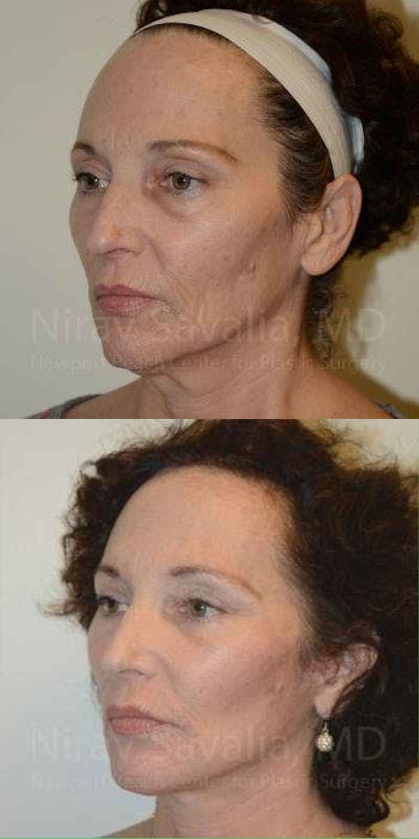 Comprehensive Facial Rejuvenation - 2