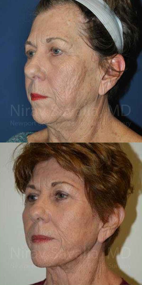 Comprehensive Facial Rejuvenation - 1